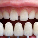 Tooth being compared to shade chart before porcelain veneers