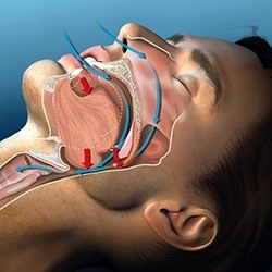 image of upper airway obstruction before sleep apnea therapy