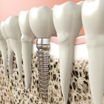 a 3D illustration of a dental implant in the jawbone