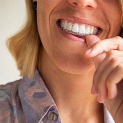 Close-up of woman putting in an Invisalign aligner